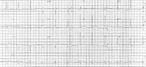 A 12 lead EKG demonstrating Wolff-Parkinson-Wh...