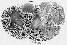 Displasta cerebela gangliocitoma.jpg