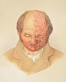 Image of a lithograph from Hebra's Atlas showing a bald man, his head slightly bent down, with herpes zoster (shingles) on face and pate.