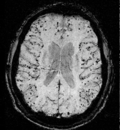 Vignette pour Angiopathie amyloïde cérébrale