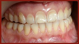 Dental erosion (hypoestrogenia) no211.jpg