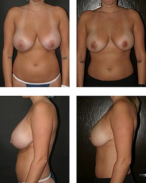 Bilateral breast reduction from utilizing lipe...