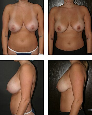 English: Bilateral breast reduction from utili...