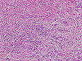 低分化型腺癌 (por2)。