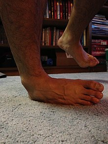 Most Common Ligament Injured Ankle Sprains