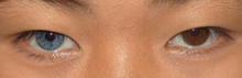 Individual with Waardenburg Syndrome Type II exhibiting complete heterochromia iridum Heterochromia plos.png