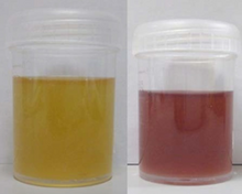 Urine of patient with porphyria.png