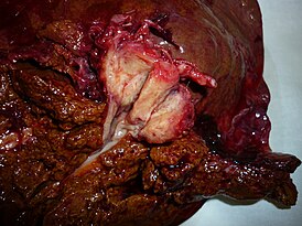 Холангиокарцинома (опухоль Клацкина) на разрезе после выполненной правосторонней гемигепатэктомии