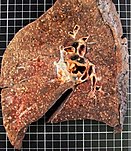 Gross pathology of miliary tuberculosis of the lung. Gross pathology of miliary tuberculosis of the lung.jpg