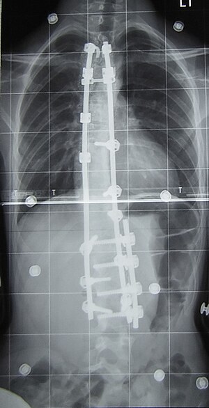 Post-operation spinal fusion surgery.