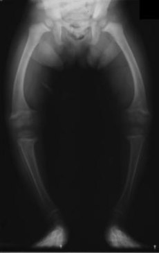 XrayRicketsLegssmall.jpg