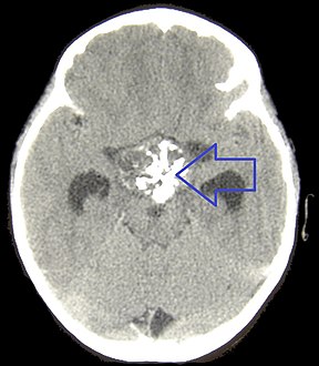CT scan showing a craniopharyngioma