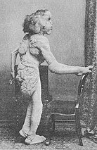 «Elefantmannen» Joseph Merrick (1862-1890) på bilder trykt i legetidsskriftet British Medical Journal da han døde som 27-åring i 1890. Merrick var freakshow-artist med en kraftig deformert kropp som fikk stor oppmerksomhet som medisinsk kuriositet i victoriatidens England.