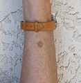A 10 mm liver spot (solar lentigo) on the forearm of a 66-year old woman