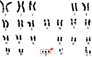 en: Karyotype of 21 trisomy (Down syndrome) fr...