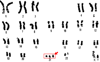 Cariotipo (conjunto de cromosomas de un individuo) mostrando una trisomía libre del par 21.