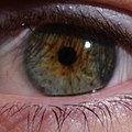 人类绿眼中央异色症的例子，带有棕色斑点。