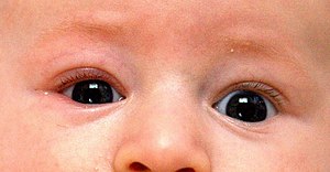 An infant with mild blepharitis (inflamed eyel...