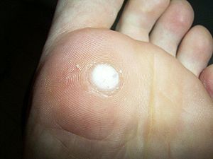 Plantar wart after treatment with salicylic ac...