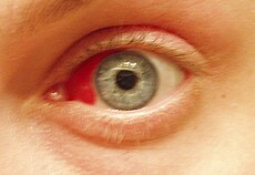 Eye Redness Causes