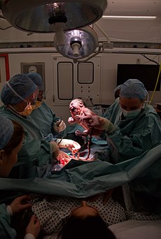 فريقٌ من أطبَّاء التوليد يعملون على إجراء ولادة قيصريَّة في مُستشفى حديث. تُظهر الصُورة اللحظة الأولى التي تَلمح الأُم فيها مولودها