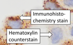 Immunohistochemistry stain versus hematoxylin counterstain. Immunohistochemistry stain versus counterstain.png