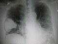 Et røntgenbillede, der viser en fremtrædende kileformet bakteriel pneumoni i højre lunge.