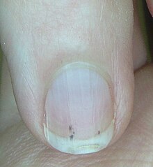 nail splinter hemorrhages
