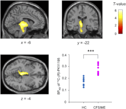 Description de l'image Statistical parametric maps of BPND of 11C-(R)-PK11195 in CFS.ME patients and healthy controls.gif.