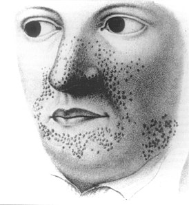 Первая известная иллюстрация заболевания, из атласа кожных болезней французского врача Пьера Райе, 1835 год