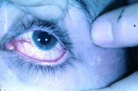 Глазная телеангиэктазия при синдроме атаксии-телеангиэктазии.