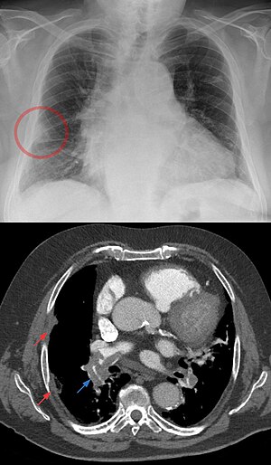 Hampton hrb bei schwerer Lungenembolie - Roe Thorax und CT axial.jpg