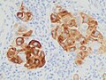 Metastatic melanoma on immunohistochemistry for Melan-A, which helps in diagnosing uncertain cases