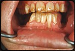 Miniatura para Fluorosis dental