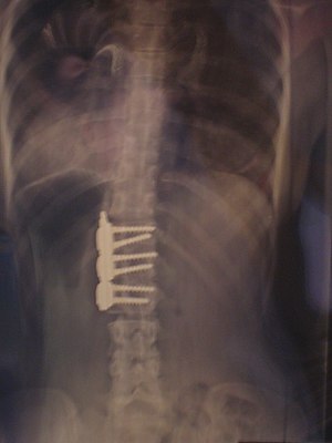 X-ray of spine after scoliosis surgery - anter...