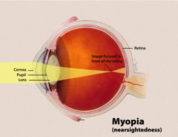 English: Diagram of Myopia in the human eye