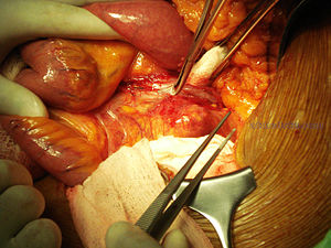 Open repaire of a AAA (Abdominal aortic aneury...