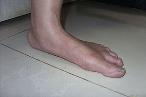 Flatfoot in a 55 years old female with ankle a...