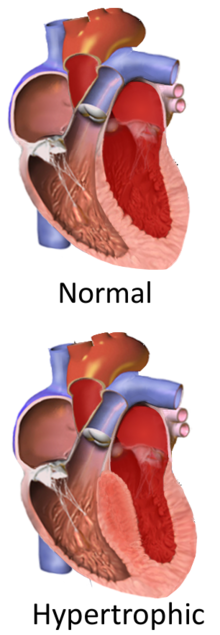 Гипертрофическая обструктивная кардиомиопатия.png