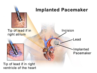 Placement of a pacemaker.