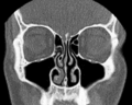 Nasenscheidewand in einer frontalen CT-Aufnahme, mittig zeigt sich die Scheidewand, jeweils davon lateral u. a. die Conchae nasales, Meatus nasi