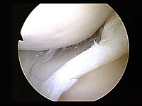 Complete tear of medial meniscus with free-flo...