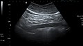 Ultrazvučni snimak trbušne aorte