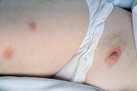 Blastomycosis of skin.jpg