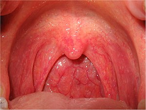 Viral pharyngitis. The oropharynx is swollen a...