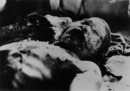 An atomic bomb victim with burns - 1 - Ninoshima Quarantine Office - 7 August 1945 - Onuka Masami.png