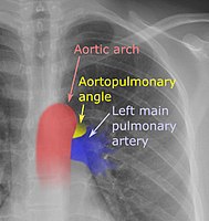 On a posteroanterior chest radiograph like this one, the left margin of the aortopulmonary space is normally seen as the "aortopulmonary angle".[1]