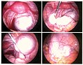 Miniatura para Endometriosis