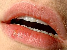 Herpes labialis.jpg