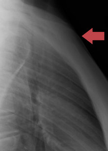 Manubrium sternal dislocation Medusterdisloca.png